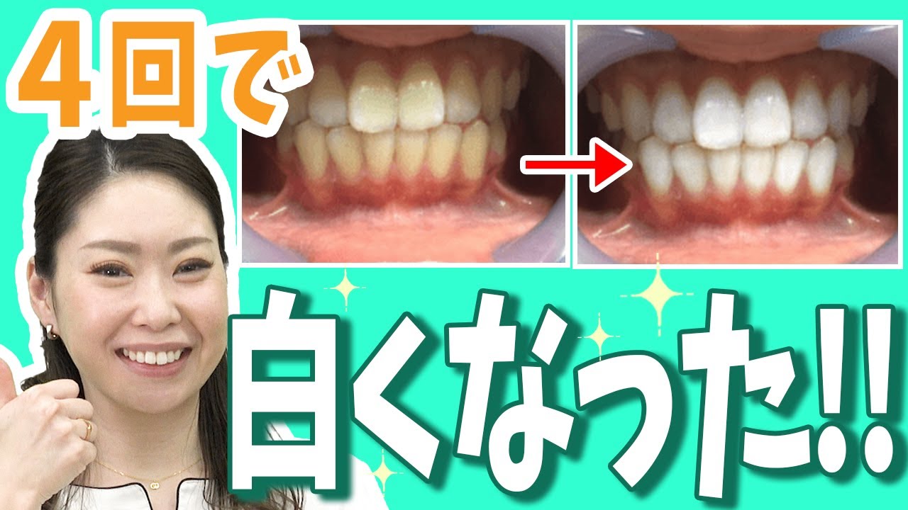 検証】セルフホワイトニングでここまで白くなりました｜ホワイトニング